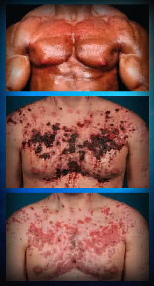 steroid taking, steroid use, steroid