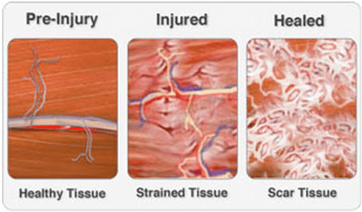 Muscle strain is due to the microscopic traumas (small “tears”) that develop during workout. Muscle strain is due to the microscopic traumas (small “tears”) that develop during workout.